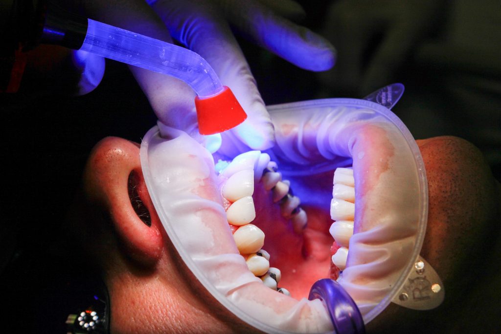טכנולוגיות מתקדמות לביצוע ציפוי שיניים