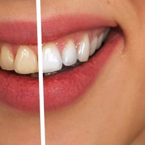 ציפוי שיניים לשיניים לבנות - איימקס